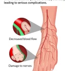 Diabetic foot nerves