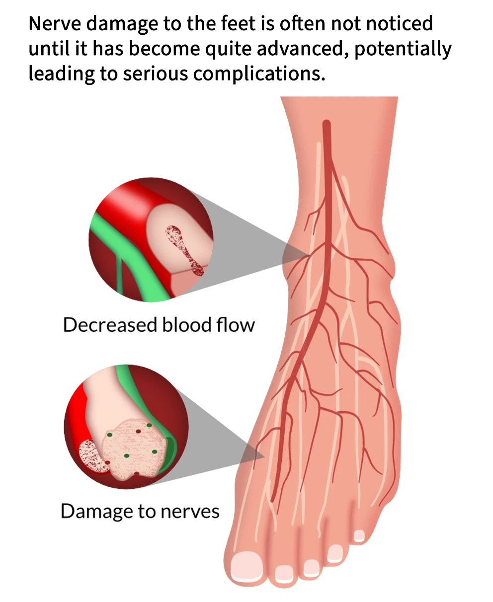 Diabetic foot nerves